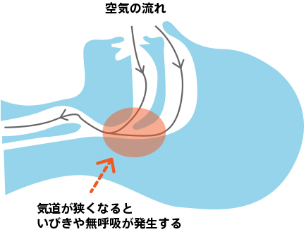 睡眠時無呼吸症候群